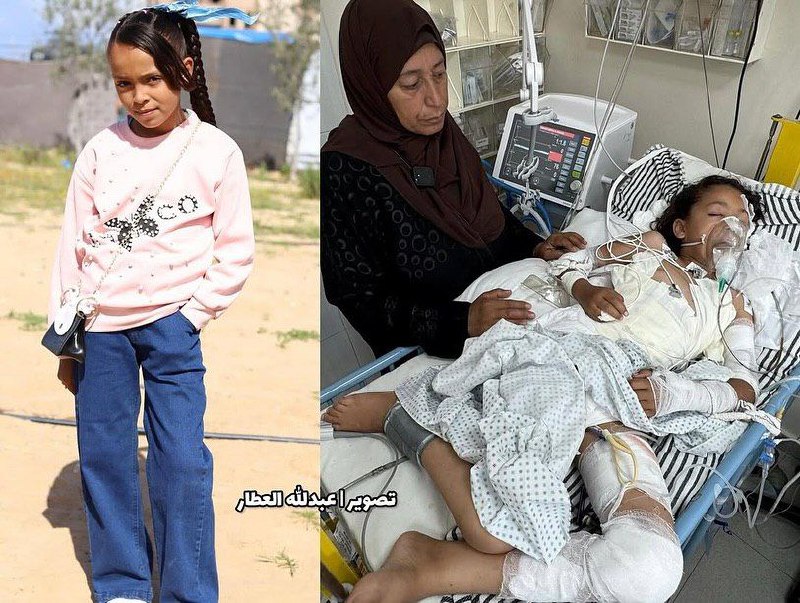 Her mother and siblings were martyred .. The child, Lian Abu Rizk (9 years old), was lying in intens