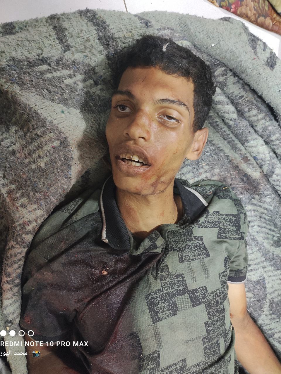 Follow -up - The arrival of a second martyr Alaa Yaqoub Al -Baysi to Al -Awda Hospital in Al -Nasayr