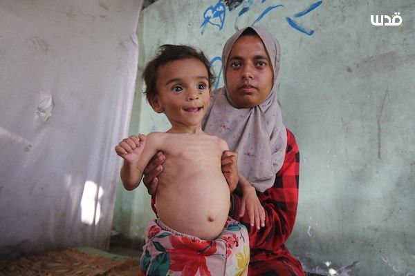He survived alone and his parents were martyred .. The baby Uday Wael Habib (9 months) receives care