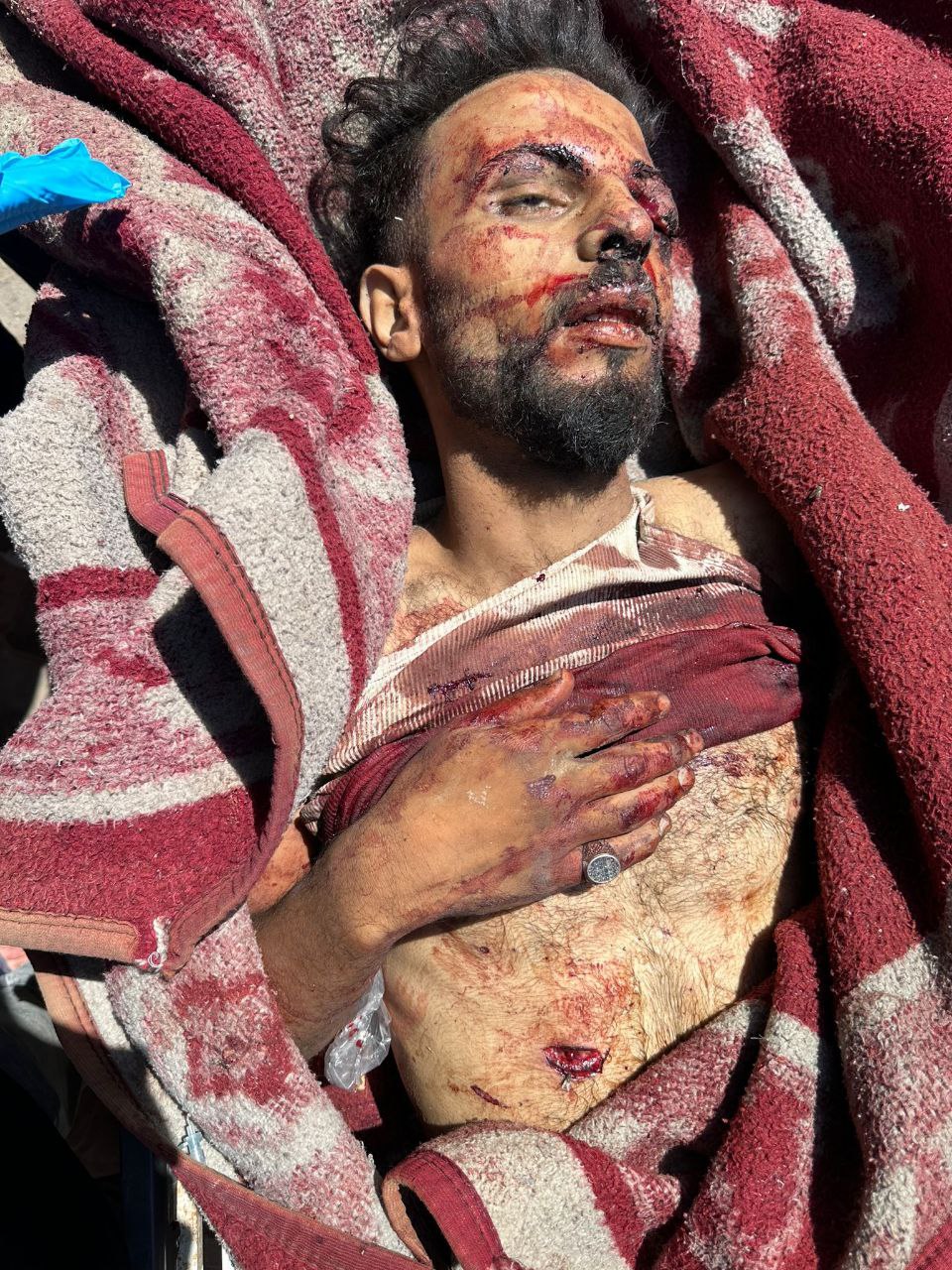 ๐๐ The arrival of an unidentified third martyr to Al -Maโdani Hospital, from the awaits of death aid