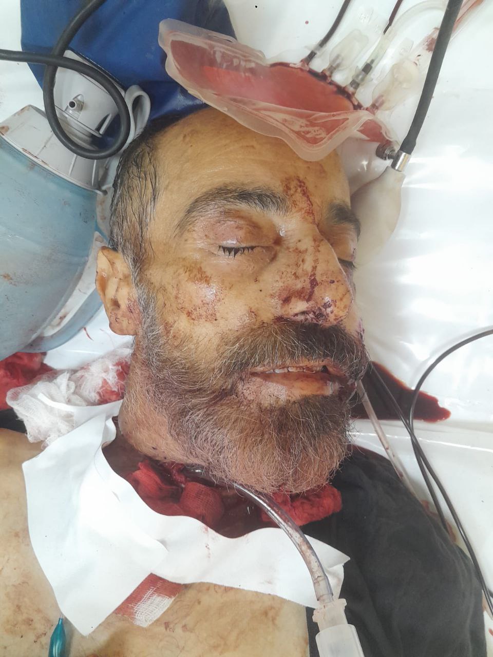The arrival of an unidentified injury from the Natsarem area to the Al -Aqsa Martyrs Hospital, his c