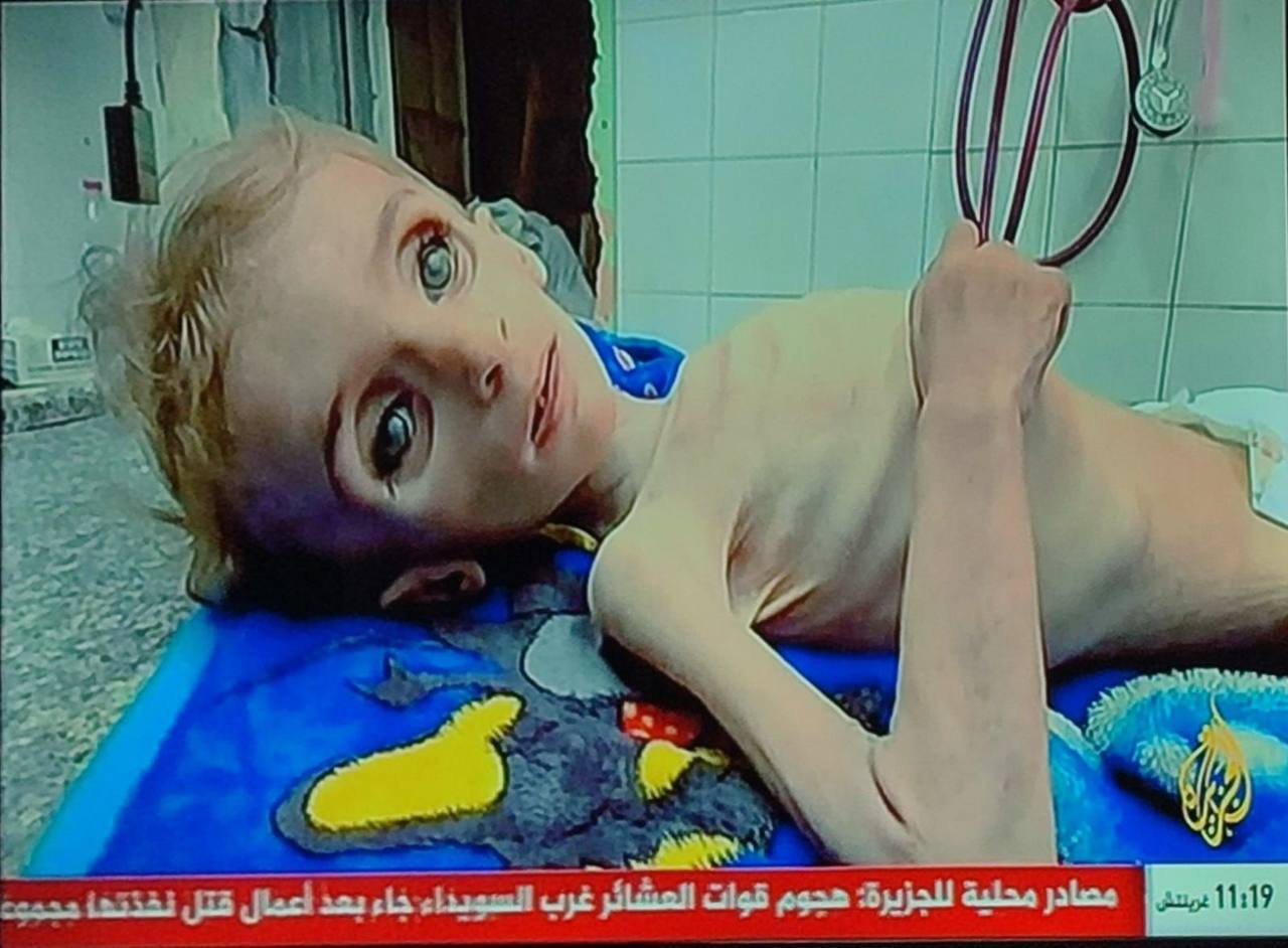 🔴 Medical source at Al -Aqsa Martyrs Hospital: The death of the child, Sana Al -Lahham, and she is a