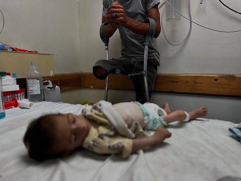 Israel murdered a child in Khan Younis due to food and nutrition deprivation (malnutrition)