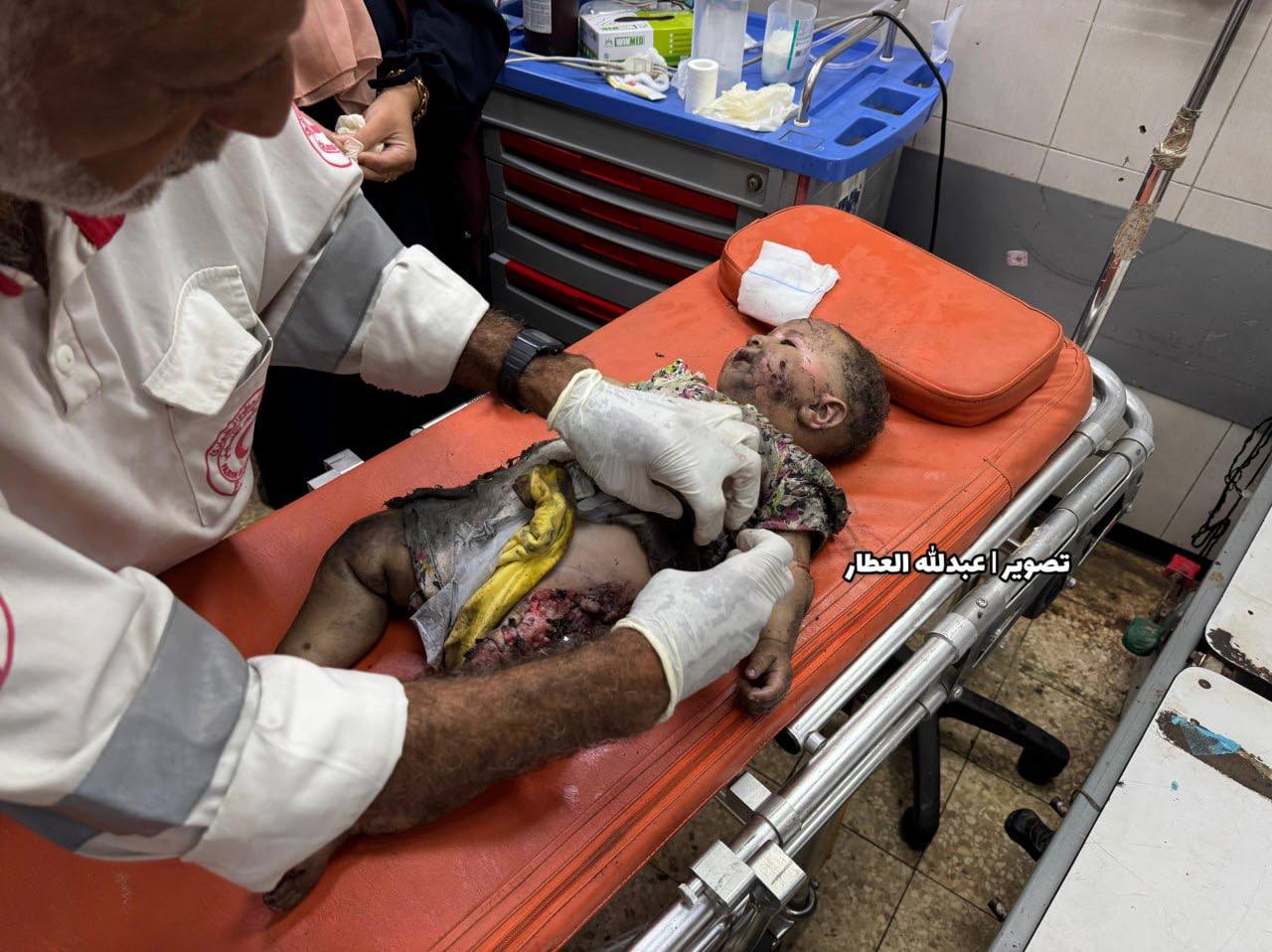 Difficult scenes for a girl who was injured by the shelling of the occupation, the tents of the disp