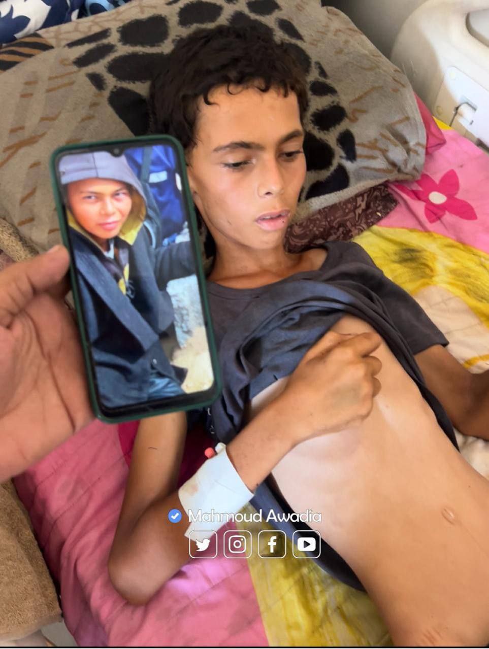 The death of the child Atef Abu Khater, who is not more than 17 years old due to malnutrition at Al