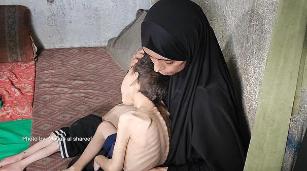 Two brotherly children face the risk of death due to malnutrition, namely Youssef Abdel Rahman Saeed