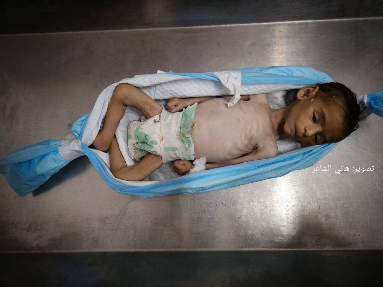 The child "Yahya Al -Najjar", who died as a result of malnutrition in Khan Yunis, in the southern Ga