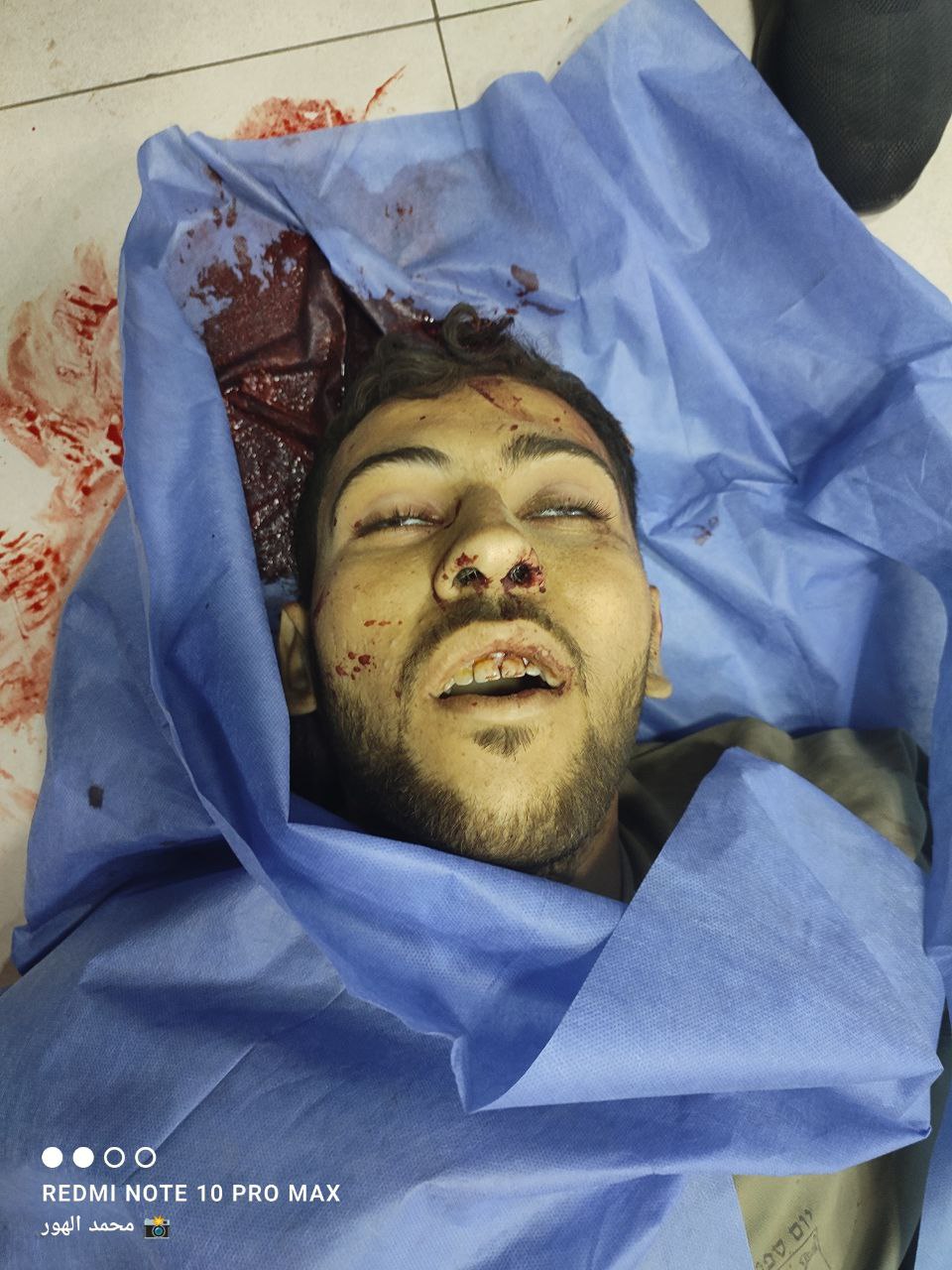 Anonymous martyr Al -Awda Hospital is present in Al -Awda Nuseirat