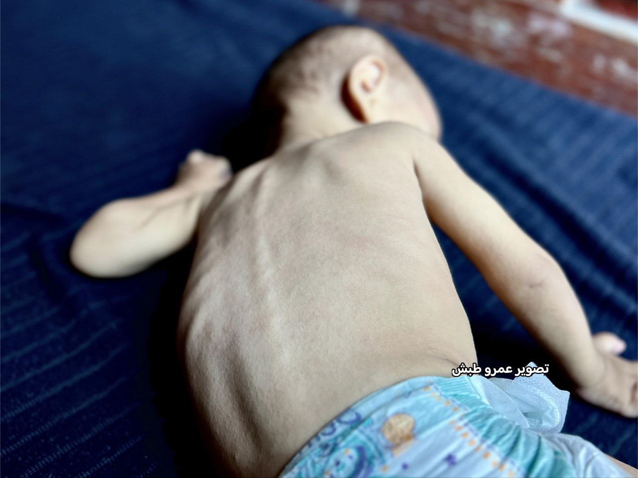 Follow -up_ The baby and the noody of the nada, did not complete her first year, and she was born in