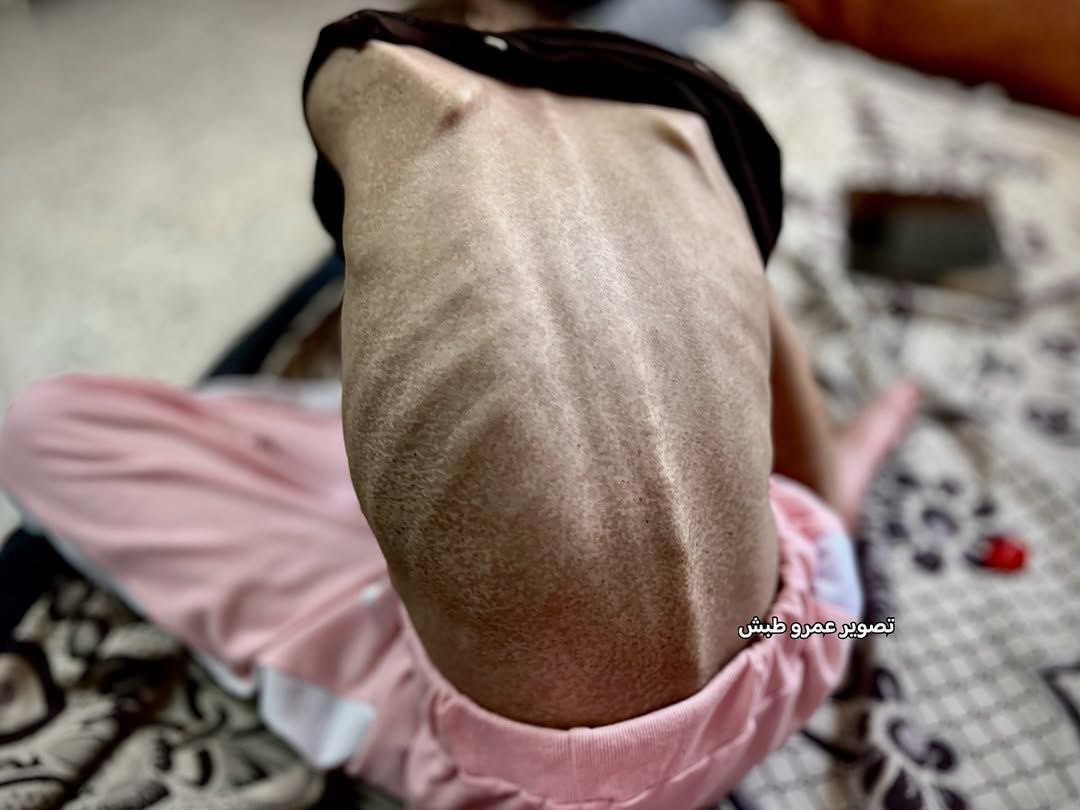 Follow -up - Hoda Abu Al -Naja (12 years old), a child who is alive, weighs 30 kg, and today there i