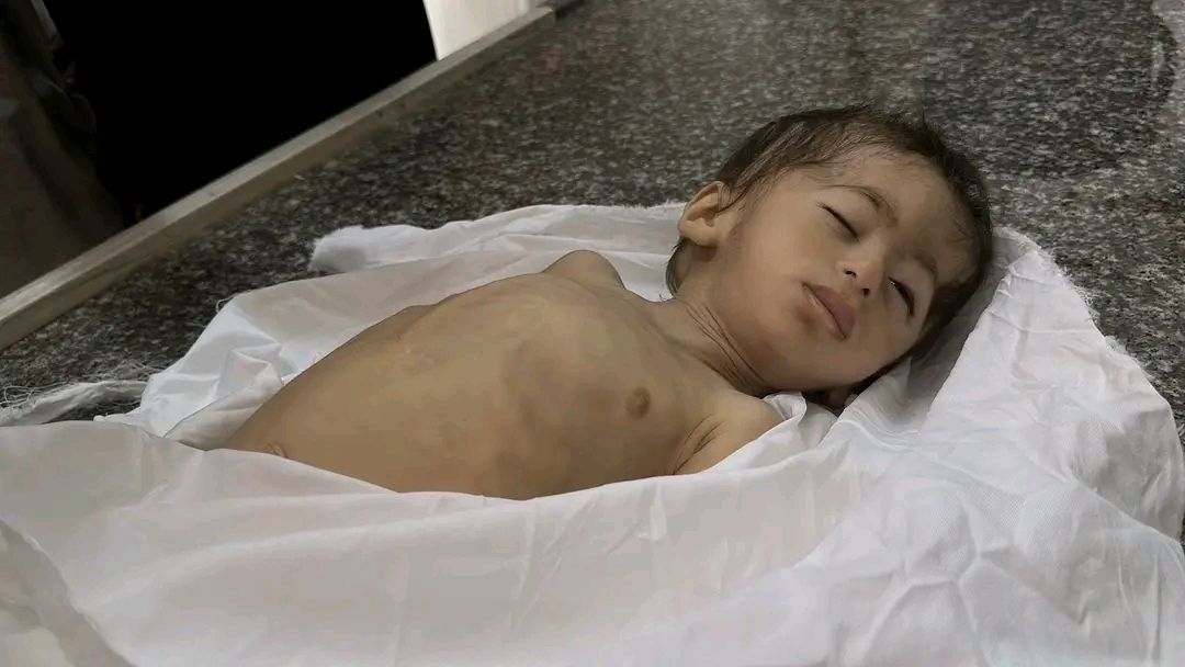 The death of the child, Makkah Al -Grabli, as a result of malnutrition and hunger, raising a number