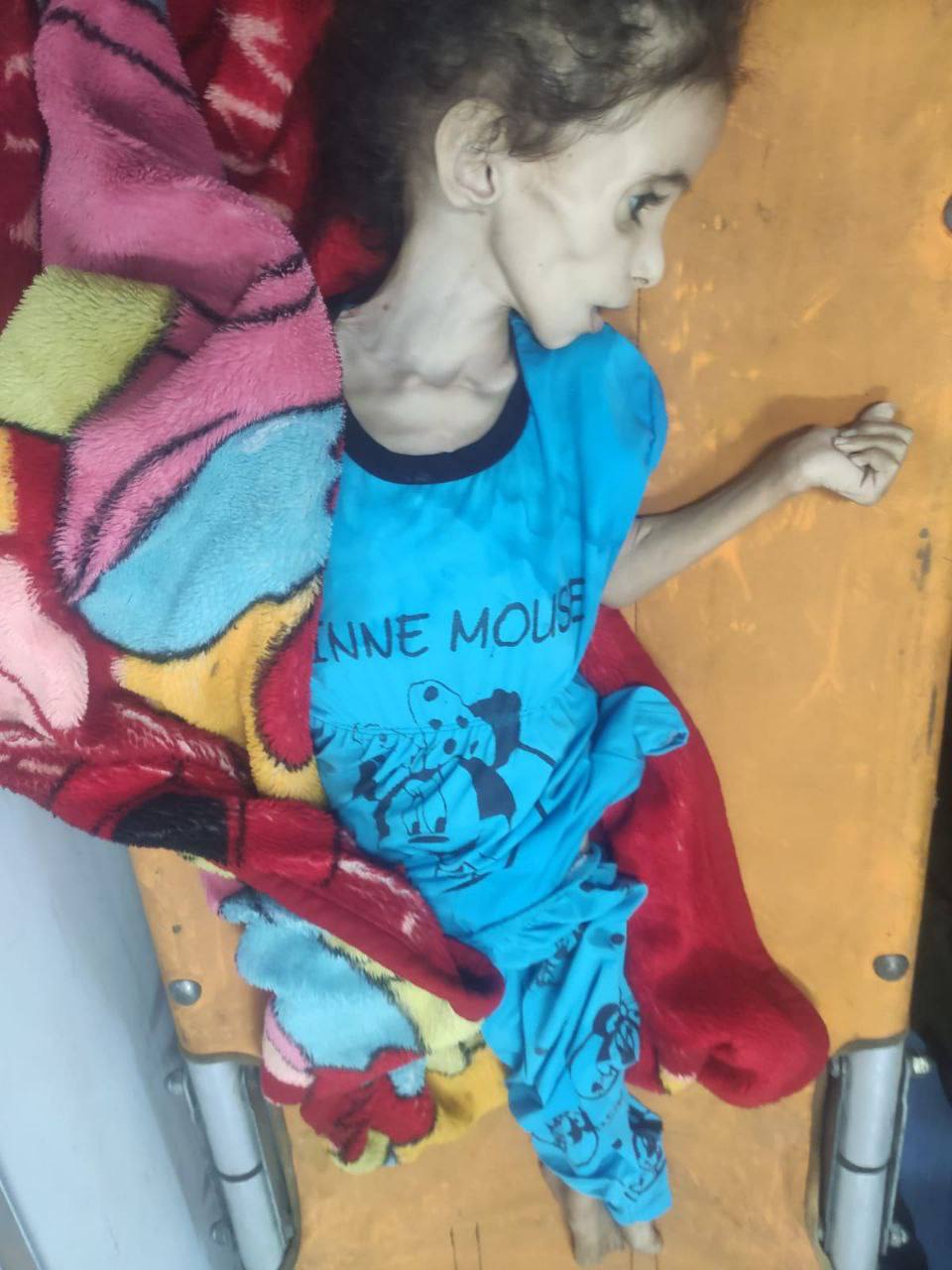 The death of the child Razan, in the central Gaza Strip due to famine