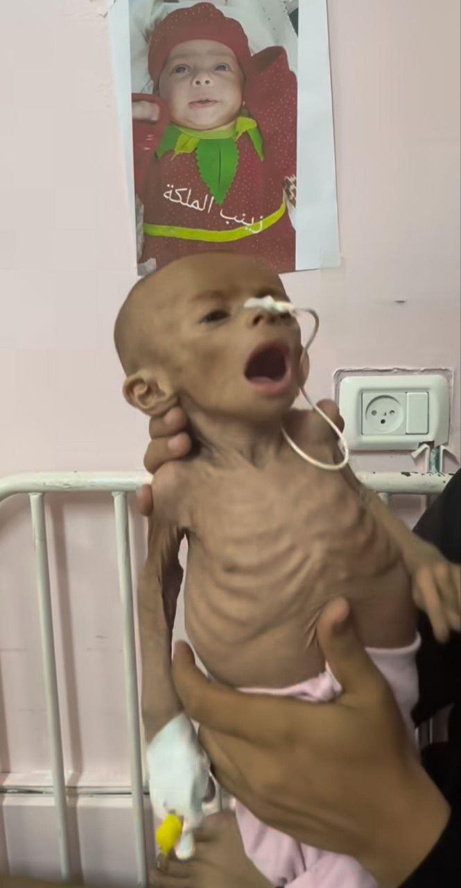 The martyrdom of the baby Zainab Abu Halib 6 months in Nasser Hospital in Khan Yunis due to malnutri