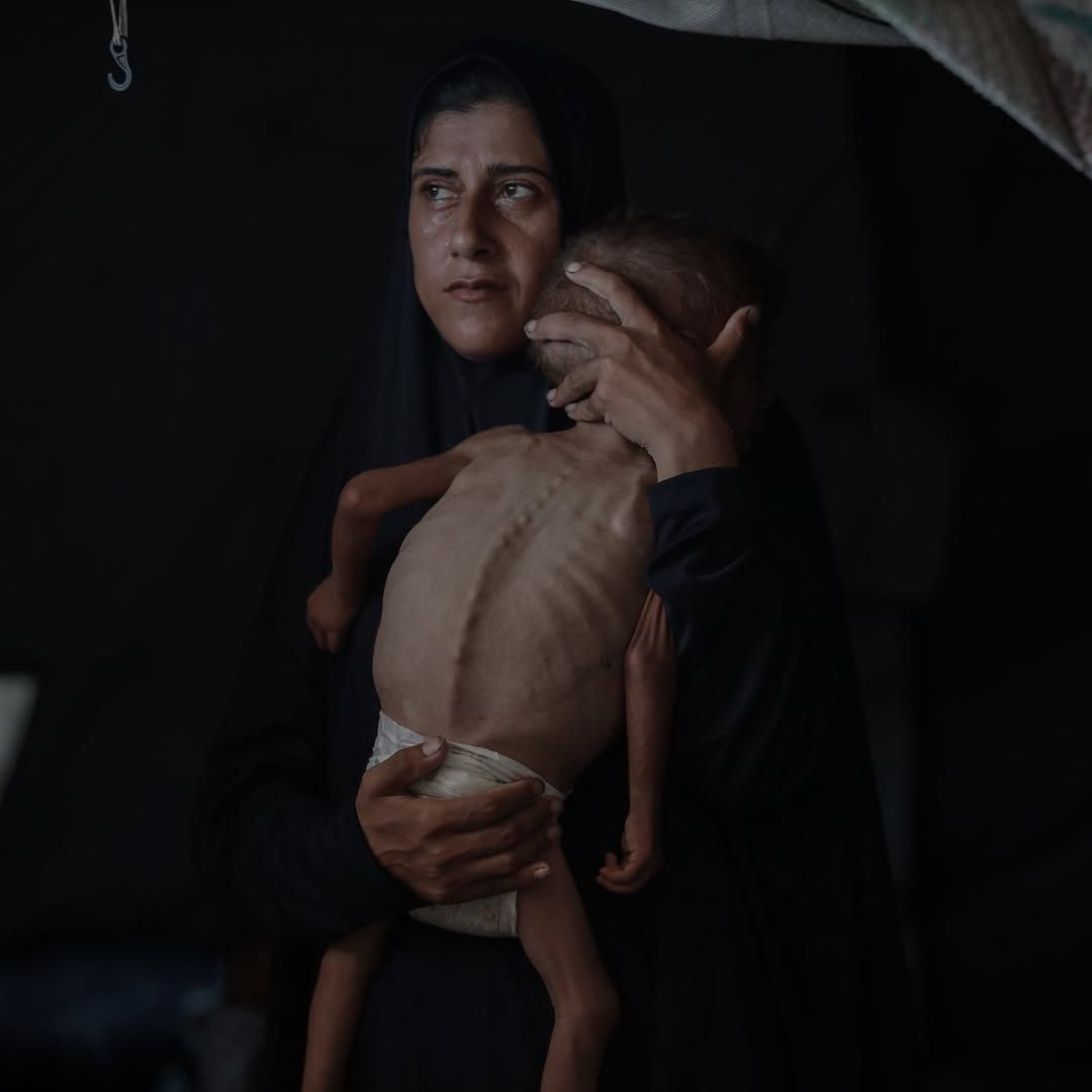 The child, Muhammad al -Mutawq, "3 years", suffers from severe malnutrition as a result of the conti