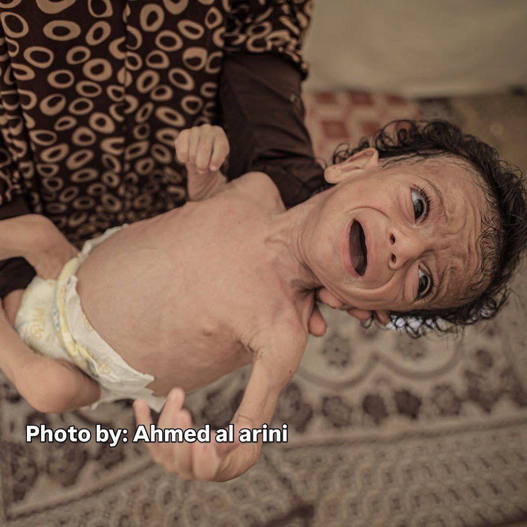 The baby Salim Mahmoud Awad, who is seven months old, suffers from a severe lack of nutrition as a r