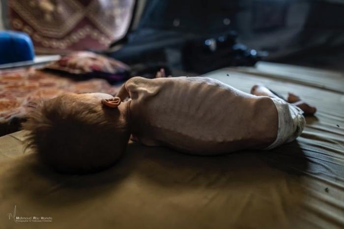 Famine exacerbates .. The martyrdom of the child Abdul Qadir Al -Fayoumi as a result of hunger and m