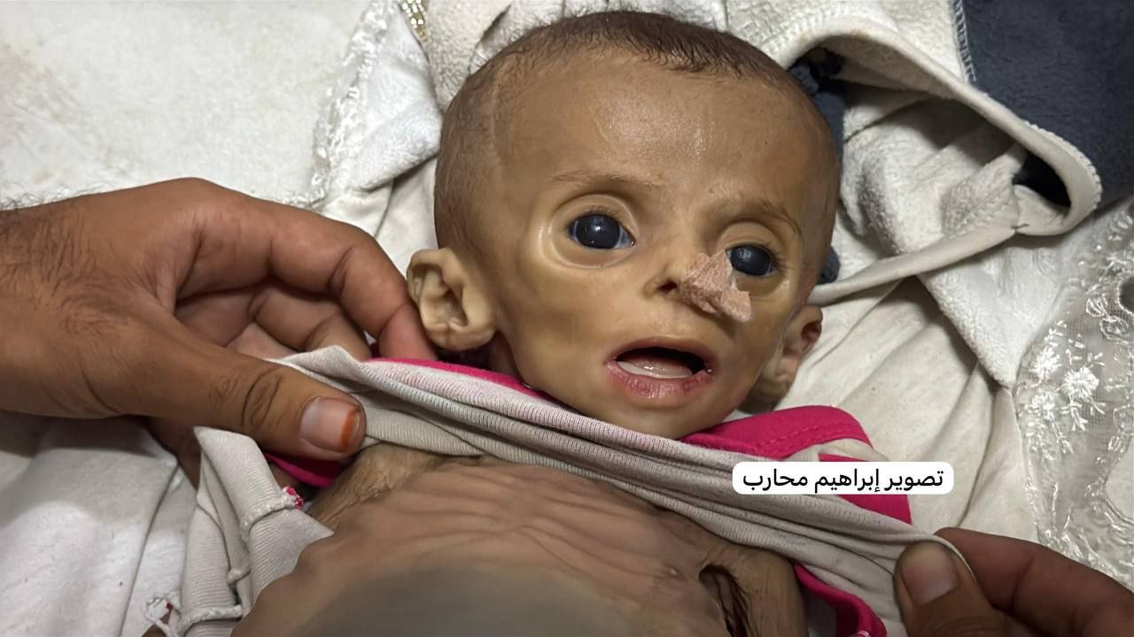 Pictures of the child Zainab Abu Halib (6 months) were martyred in Nasser Hospital affected by sever