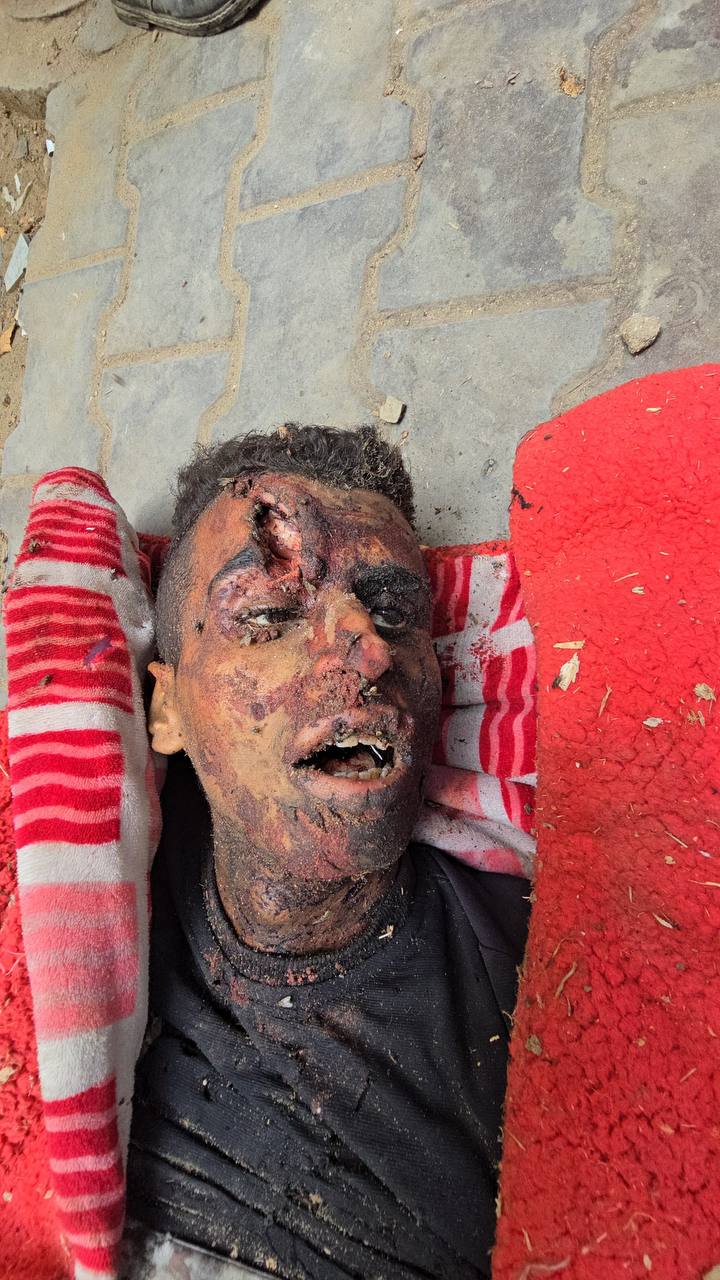 Anonymous martyr at Al -Shifa Medical Hospital from targeting in the Karama area this afternoon.