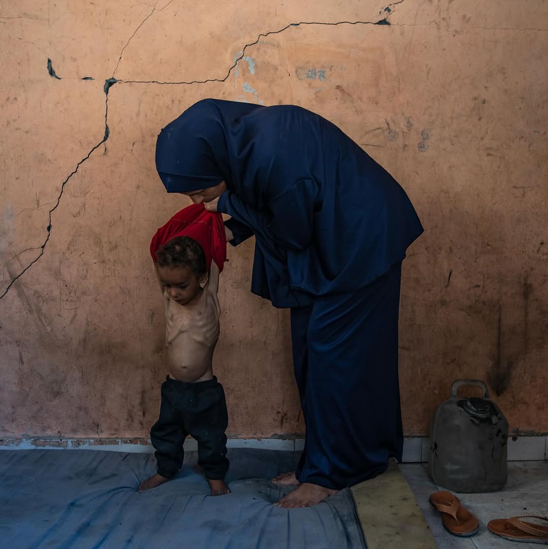 The child weighs Abu Fall, "two years", who suffers from severe malnutrition as a result of the seve