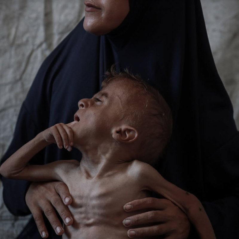 The child, Muhammad al -Mutawq, "3 years", suffers from severe malnutrition as a result of the conti