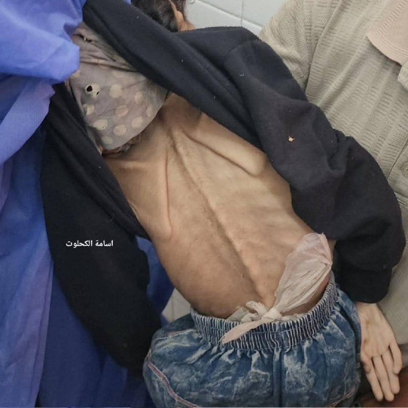 Today, the child, Nour Abu Na'aa, died, 10 years, due to the complications of severe malnutrition as