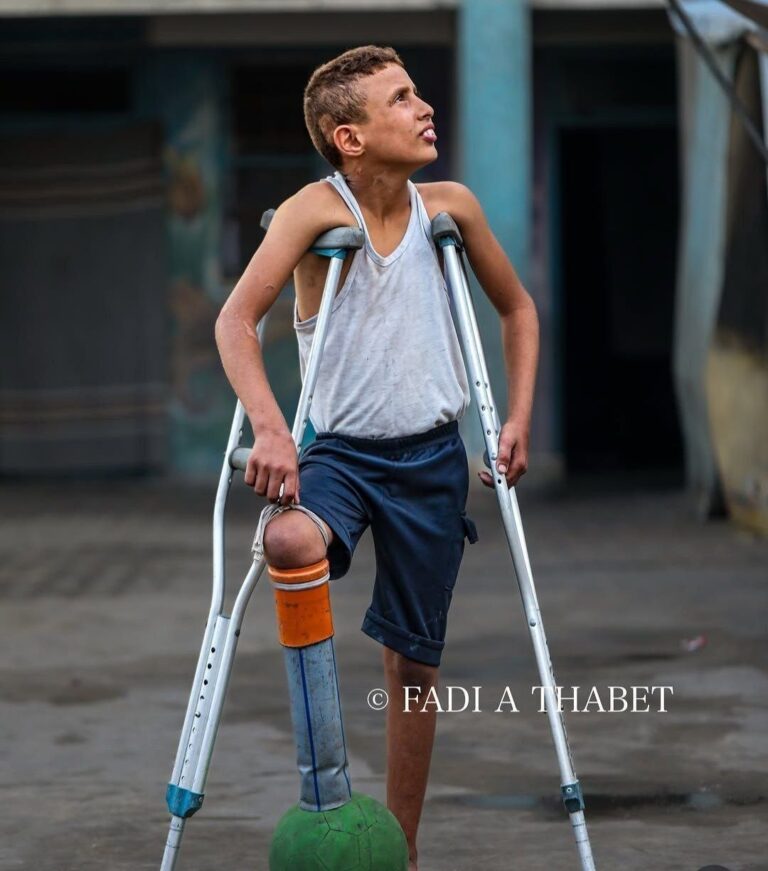 “He could not find prosthetic limbs, so he made a leg for himself out of pipes and pieces of plastic