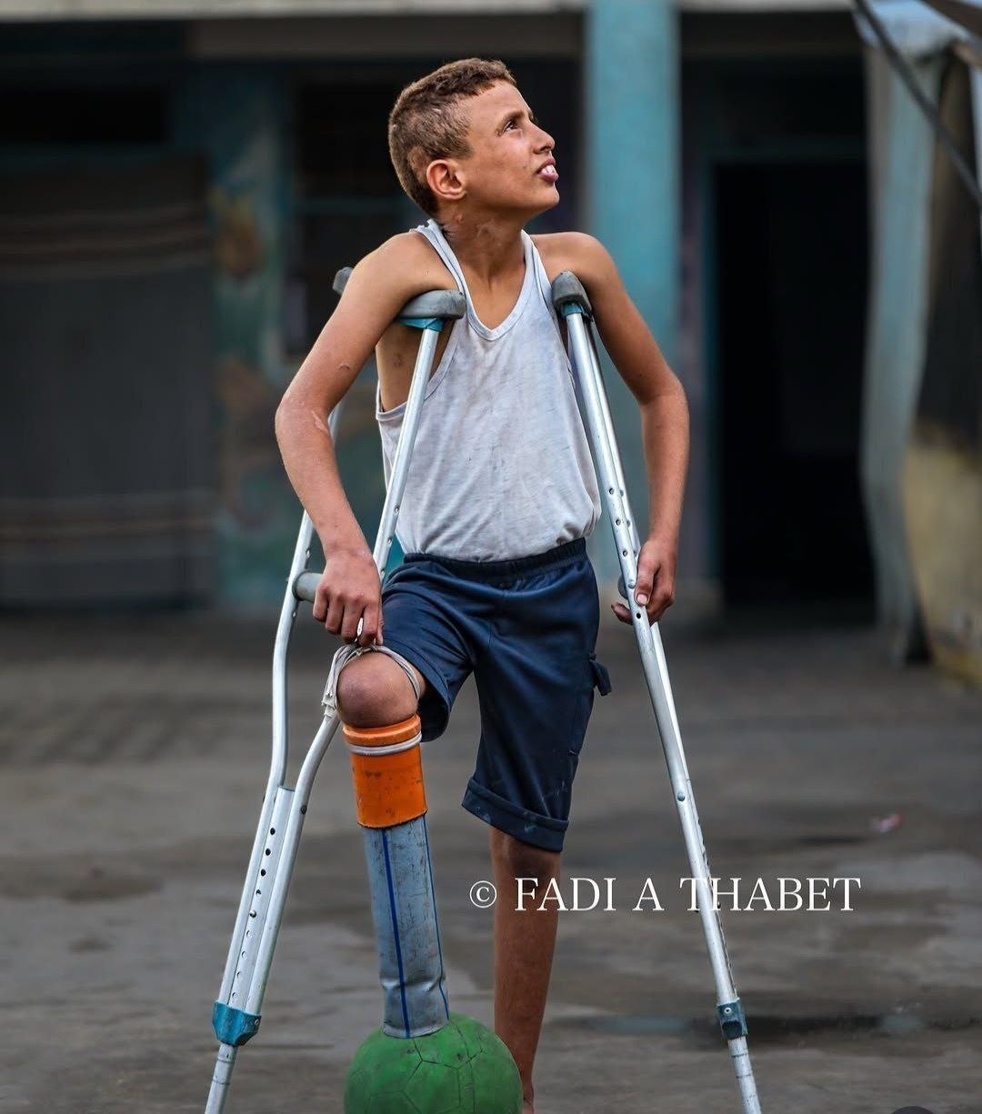 “He could not find prosthetic limbs, so he made a leg for himself out of pipes and pieces of plastic